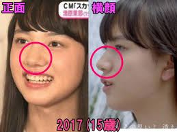 整形疑惑を検証！自然な変化か人工的なものか2